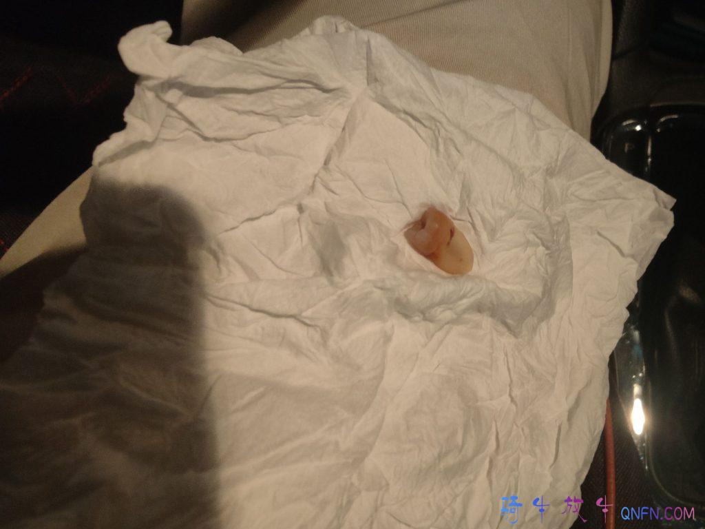 牙疼了几个月终于掉了